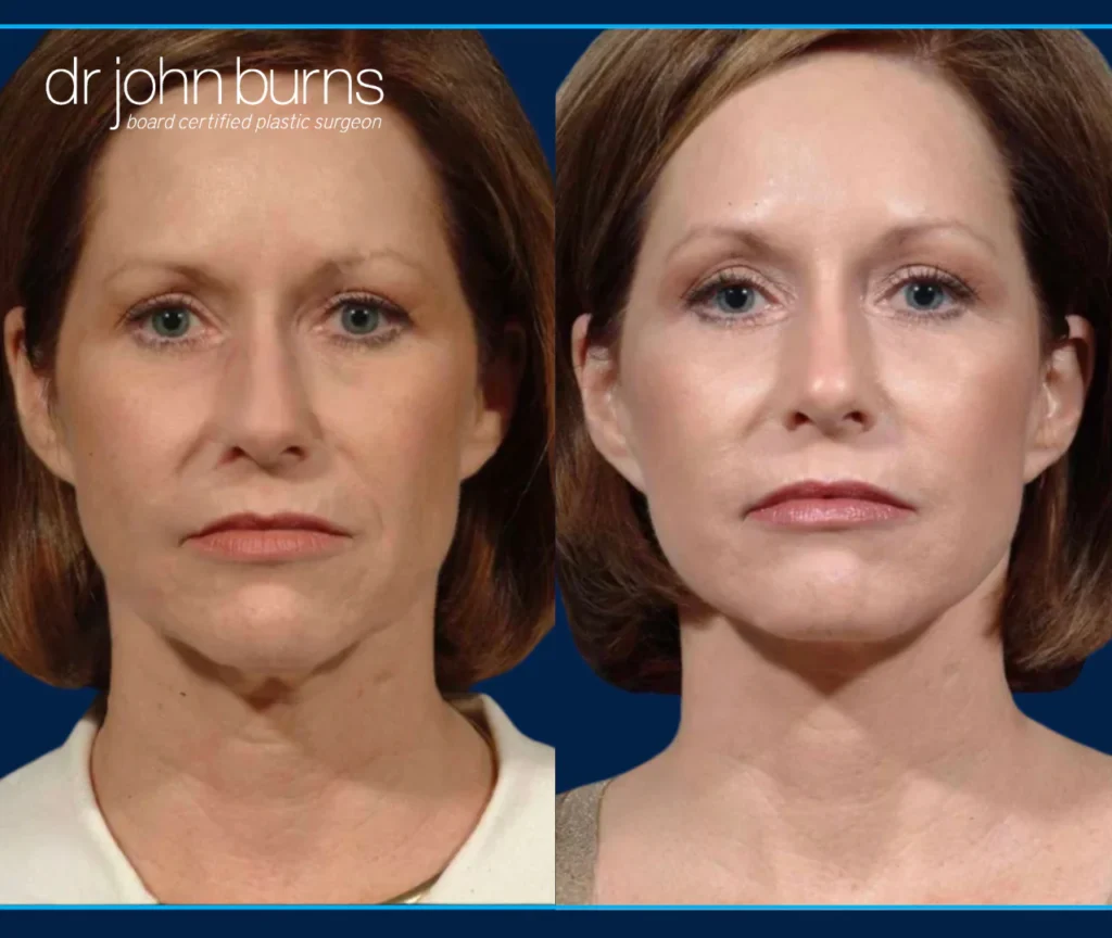 When Beauty Goes Wrong: Understanding the Implications of a Botched Mini Face Lift